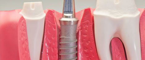 Segosalud prótesis dental